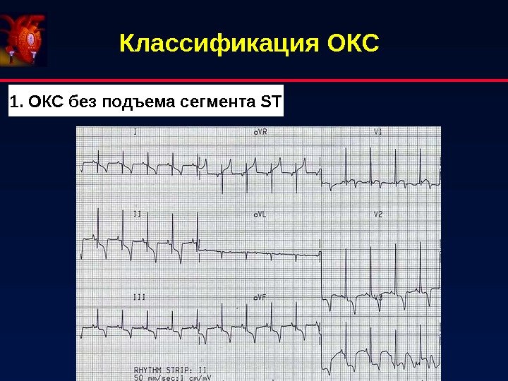 Классификация ОКС 1. ОКС без подъема сегмента ST 