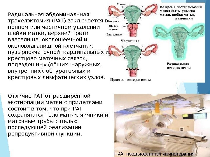Радикальная абдоминальная трахелэктомия (РАТ) заключается в полном или частичном удалении шейки матки, верхней трети