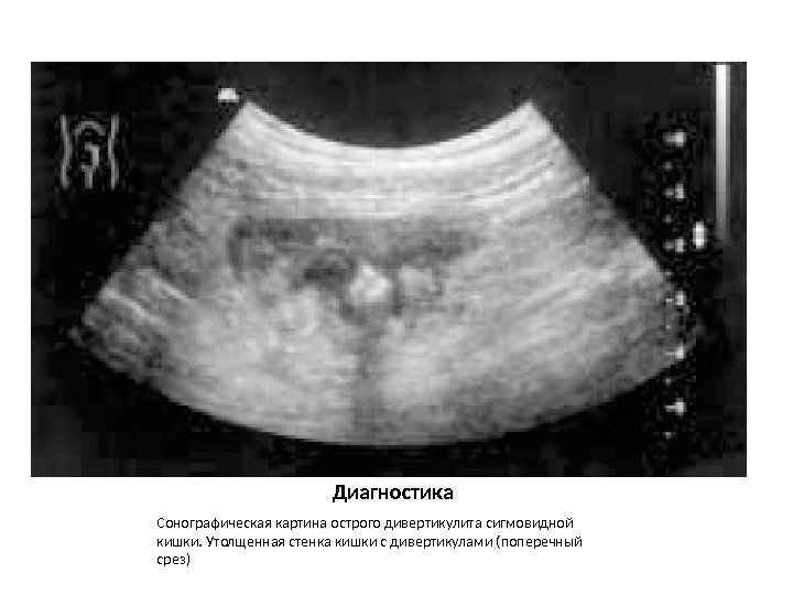 Диагностика Сонографическая картина острого дивертикулита сигмовидной кишки. Утолщенная стенка кишки с дивертикулами (поперечный срез)