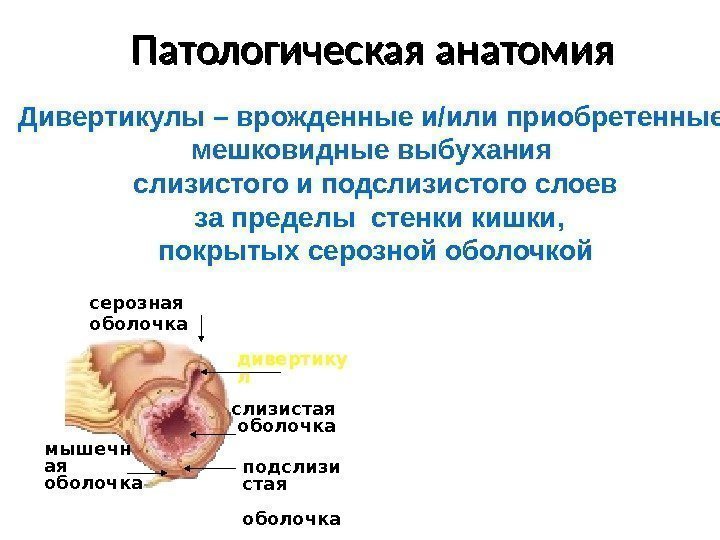 Патологическая анатомия Дивертикулы – врожденные и/или приобретенные мешковидные выбухания слизистого и подслизистого слоев 