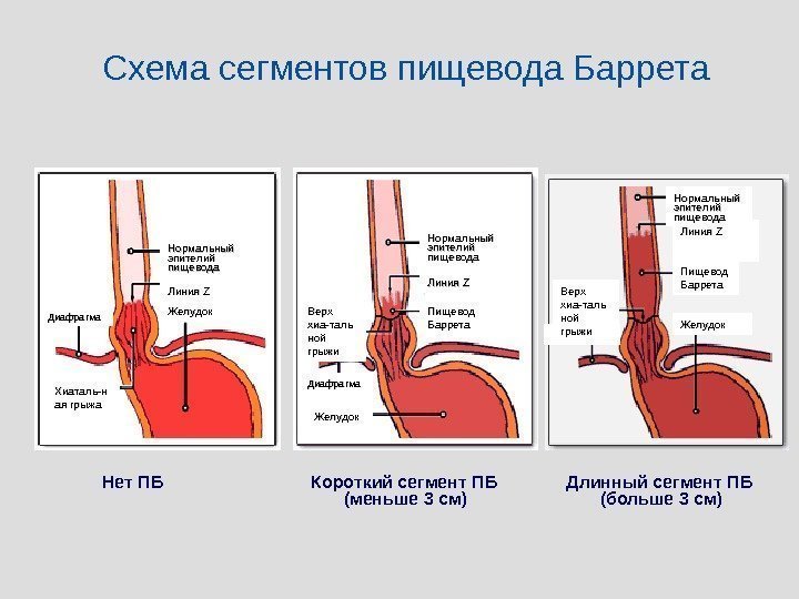 Нормальный эпителий пищевода Линия ZZ Желудок Диафрагма Хиаталь-н ая грыжа Нормальный эпителий пищевода Линия