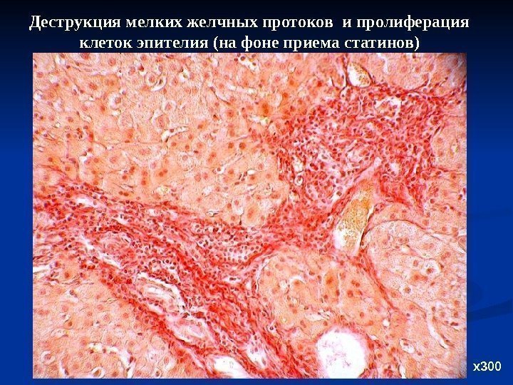 Деструкция мелких желчных протоков и пролиферация клеток эпителия (на фоне приема статинов) х300 