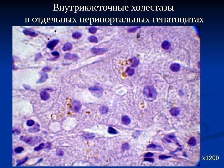 Внутриклеточные холестазы в отдельных перипортальных гепатоцитах х1200 