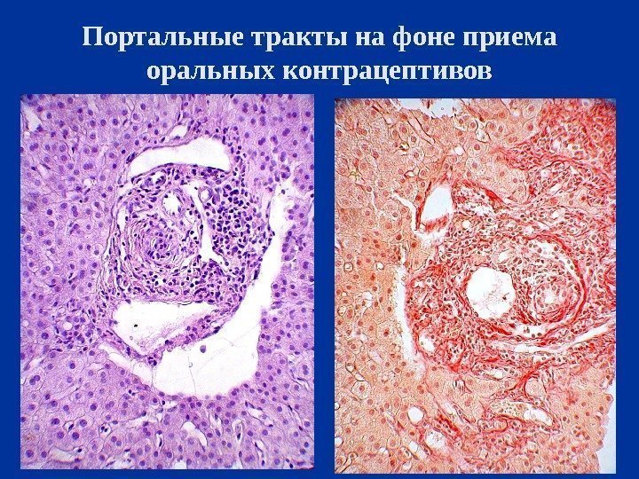 Портальные тракты на фоне приема оральных контрацептивов 