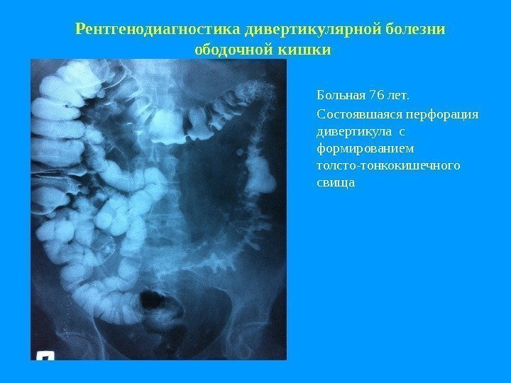 Рентгенодиагностика дивертикулярной болезни  ободочной кишки Больная 76 лет.  Состоявшаяся перфорация дивертикула с