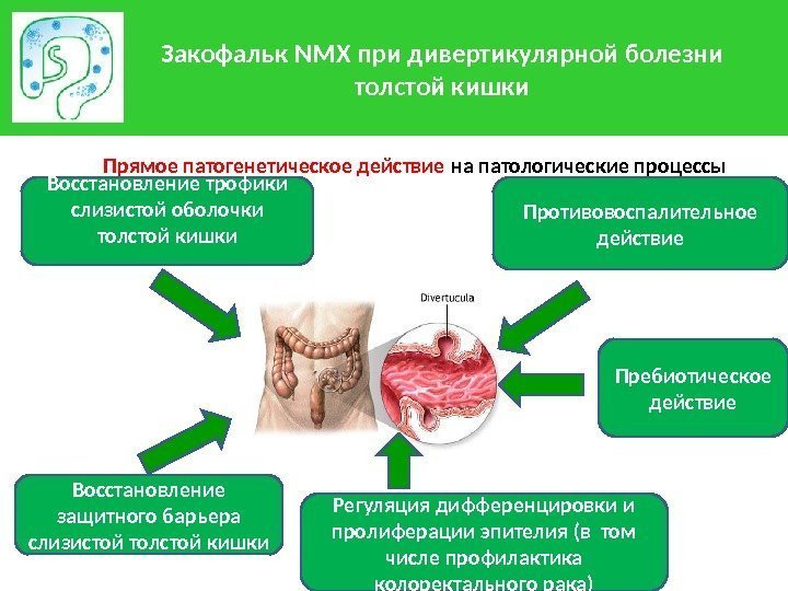 Закофальк NMX при дивертикулярной болезни толстой кишки Прямое патогенетическое действие на патологические процессы Восстановление
