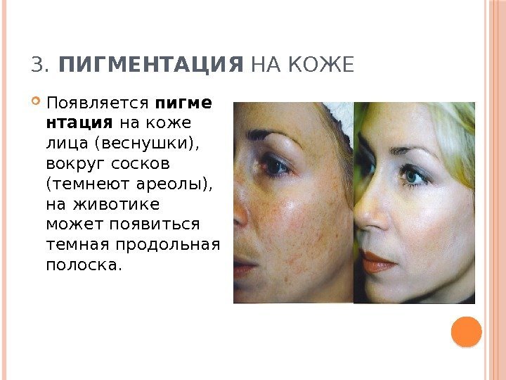 3.  ПИГМЕНТАЦИЯ НА КОЖЕ  Появляется пигме нтация на коже лица (веснушки), 