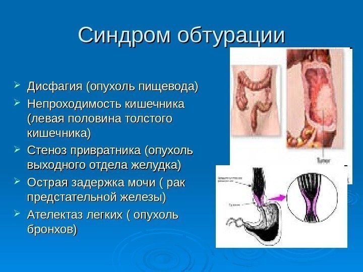   Синдром обтурации Дисфагия (опухоль пищевода) Непроходимость кишечника (левая половина толстого кишечника) Стеноз