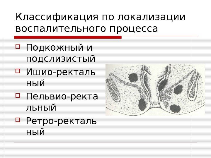   Классификация по локализации воспалительного процесса Подкожный и подслизистый Ишио-ректаль ный Пельвио-ректа льный