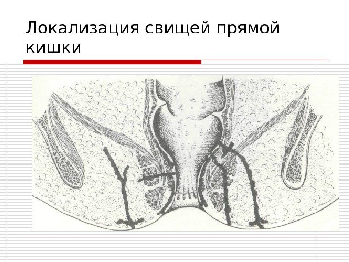   Локализация свищей прямой кишки 