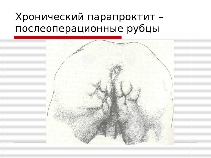   Хронический парапроктит – послеоперационные рубцы 