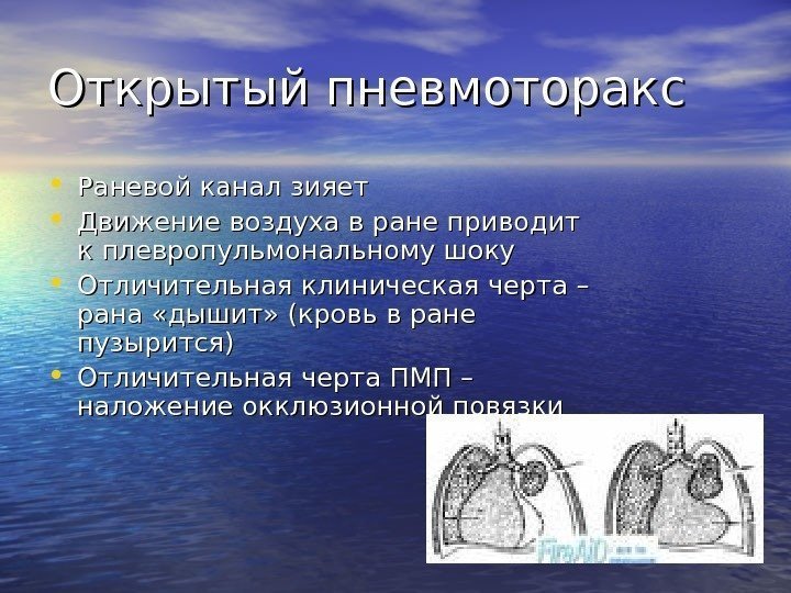   Открытый пневмоторакс • Раневой канал зияет • Движение воздуха в ране приводит