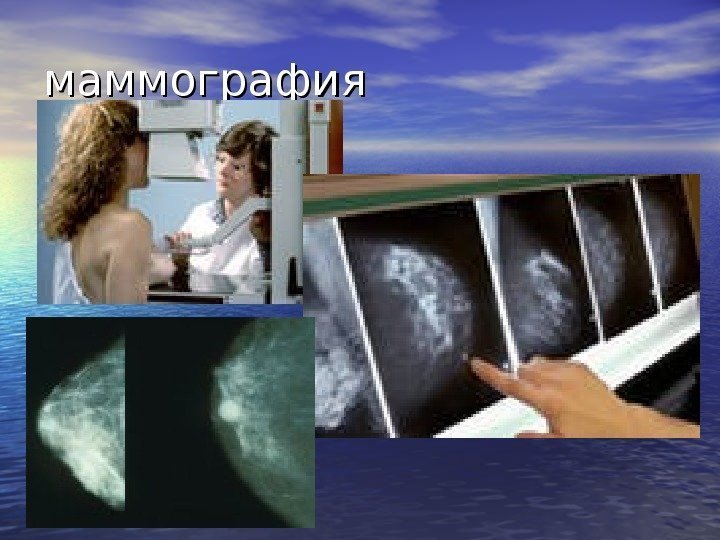   маммография 