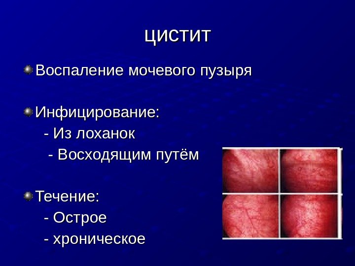   цистит Воспаление мочевого пузыря Инфицирование:   - Из лоханок  