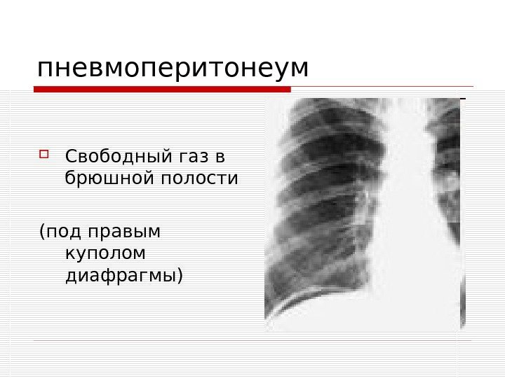   пневмоперитонеум Свободный газ в брюшной полости (под правым куполом диафрагмы) 