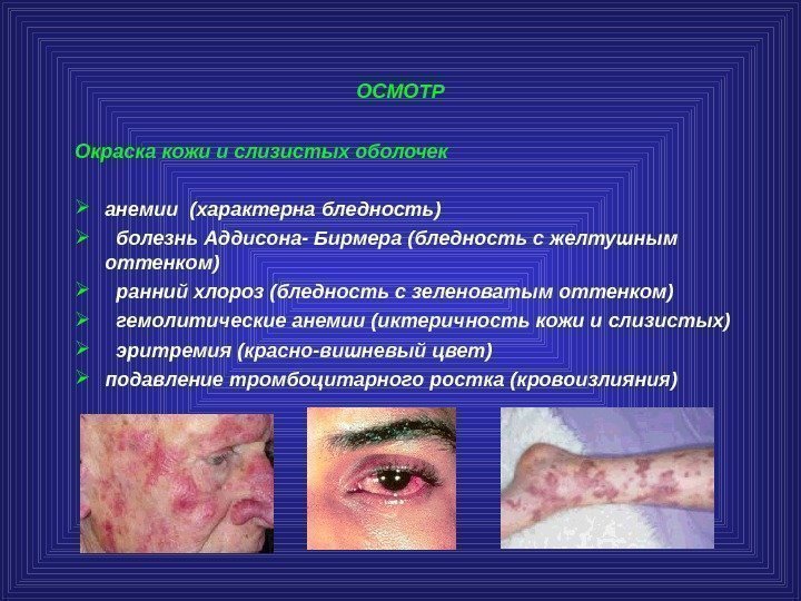 ОСМОТР Окраска кожи и слизистых оболочек анемии  (характерна бледность ) болезнь Аддисона- Бирмера