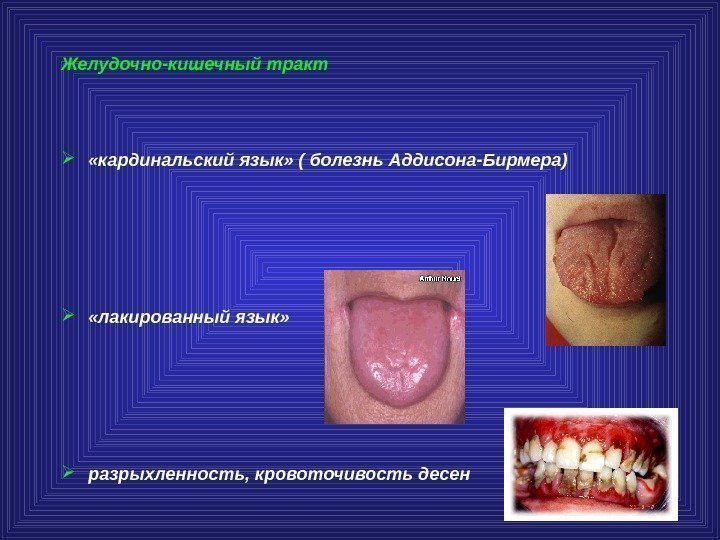 Желудочно-кишечный тракт  «кардинальский язык» ( болезнь Аддисона-Бирмера)  «лакированный язык»  разрыхленность, кровоточивость