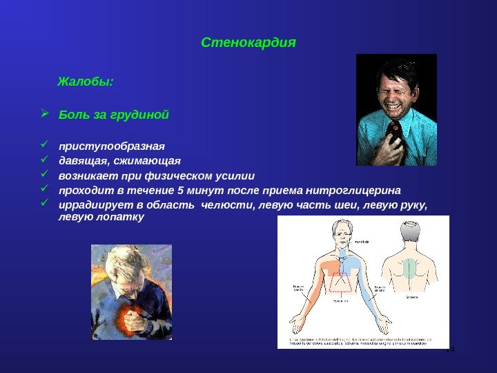 14 Стенокардия  Жалобы:  Боль за грудиной  приступообразная давящая, сжимающая  возникает