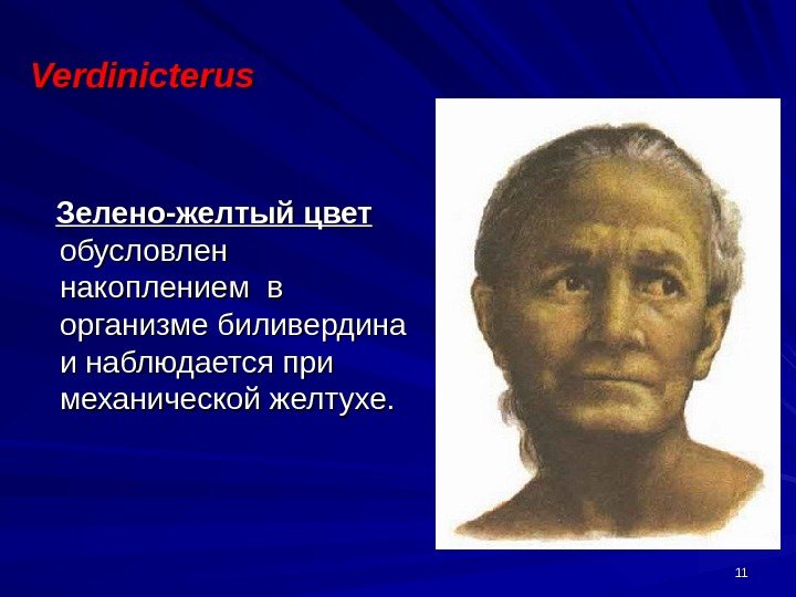 1111 Verdinicterus   Зелено-желтый цвет  обусловлен накоплением в организме биливердина и наблюдается