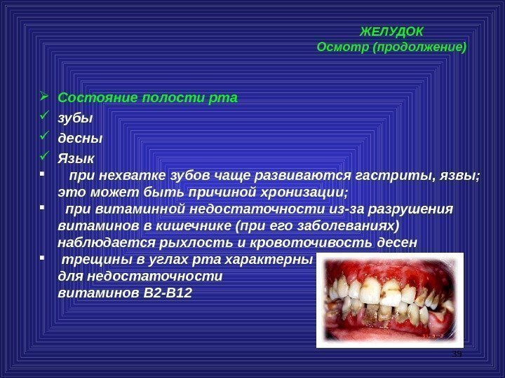 39 ЖЕЛУДОК Осмотр (продолжение) Состояние полости рта зубы десны Язык при нехватке зубов чаще