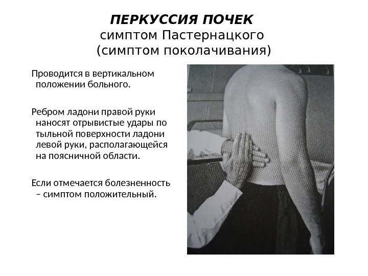 ПЕРКУССИЯ ПОЧЕК симптом Пастернацкого (симптом поколачивания) Проводится в вертикальном положении больного.   Ребром