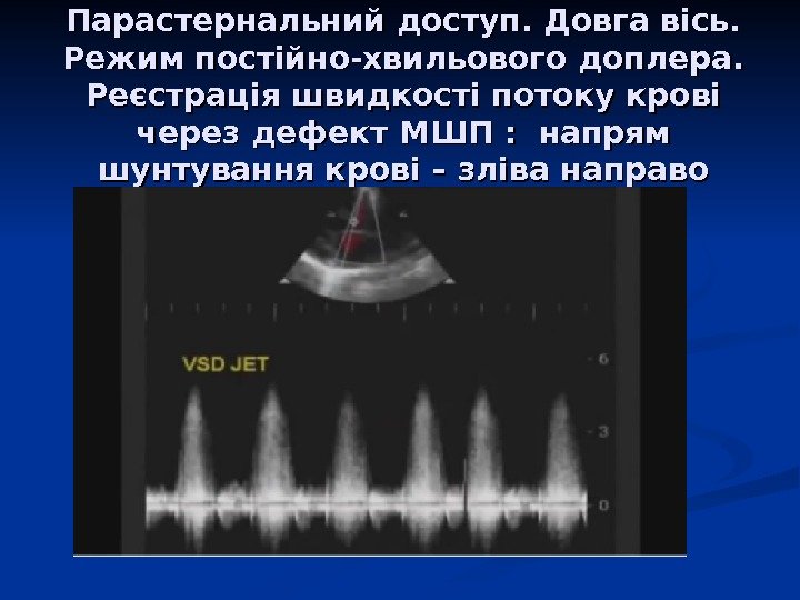 Парастернальний доступ. Довга вісь.  Режим постійно-хвильового доплера.  Реєстрація швидкості потоку крові через