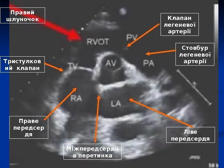 Правий шлуночок Міжпередсердн а перетинка Ліве передсердя. Праве передсер дя Стовбур легеневої артеріїКлапан легеневої