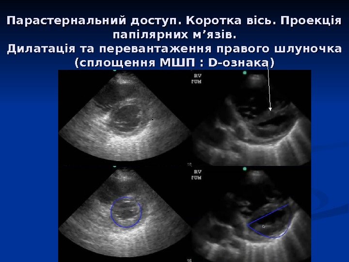 Парастернальний доступ. Коротка вісь. Проекція папілярних м ’’ язяз ів. Дилатація та перевантаження правого