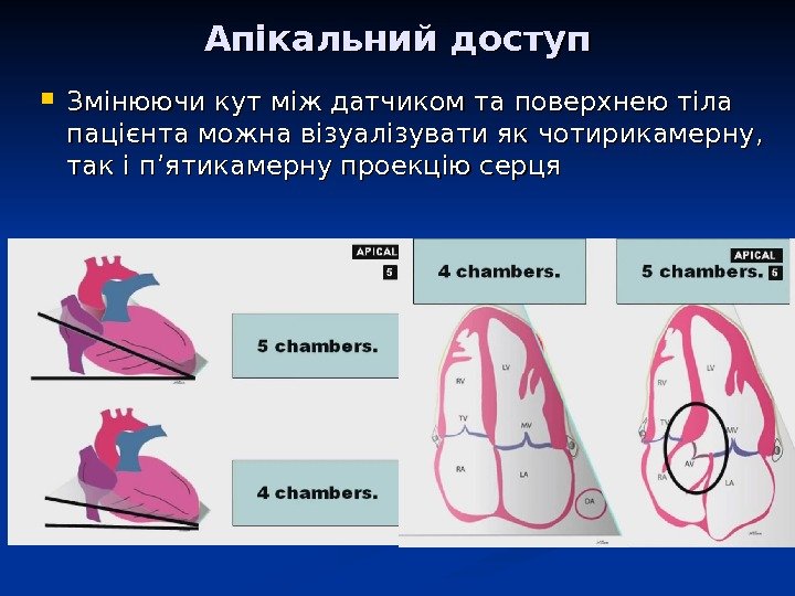 Апікальний доступ Змінюючи кут між датчиком та поверхнею тіла пацієнта можна візуалізувати як чотирикамерну,