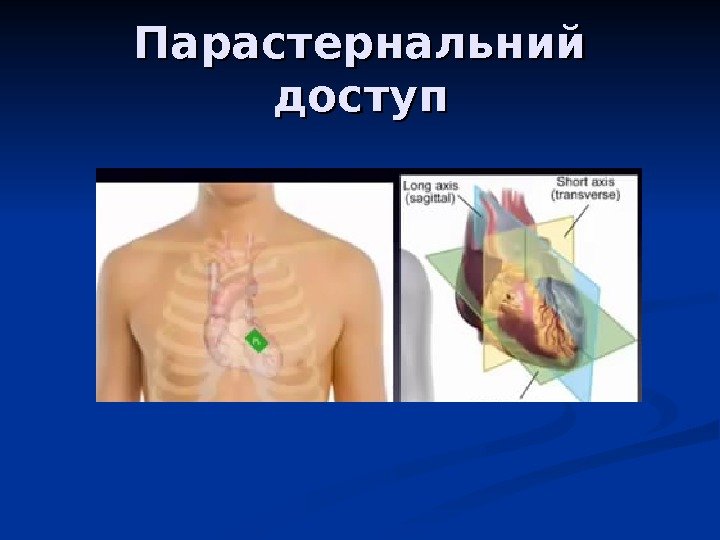 Парастернальний доступ 