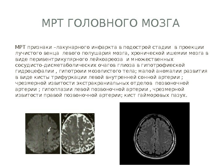 МРТ ГОЛОВНОГО МОЗГА МРТ признаки –лакунарного инфаркта в подострой стадии в проекции лучистого венца