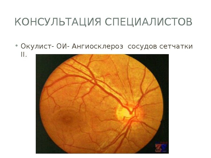 КОНСУЛЬТАЦИЯ СПЕЦИАЛИСТОВ  • Окулист- ОИ- Ангиосклероз сосудов сетчатки II.  