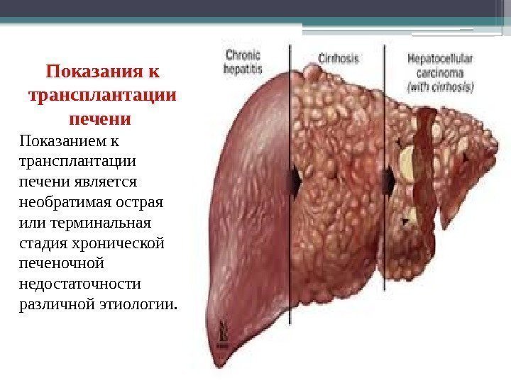 Показания к трансплантации печени Показанием к трансплантации печени является необратимая острая или терминальная стадия