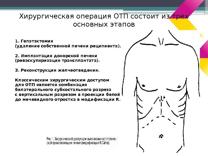 1. Гепатэктомия (удаление собственной печени реципиента). 2. Имплантация донорской печени (реваскуляризация трансплантата). 3. Реконструкция