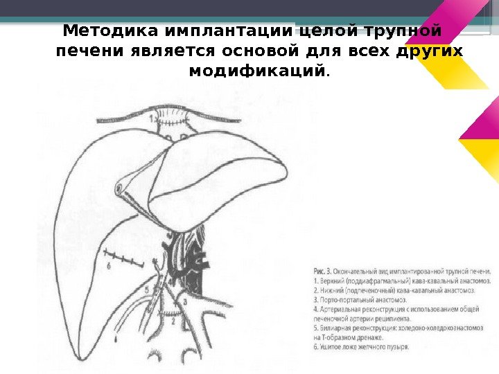 Методика имплантации целой трупной печени является основой для всех других модификаций.   