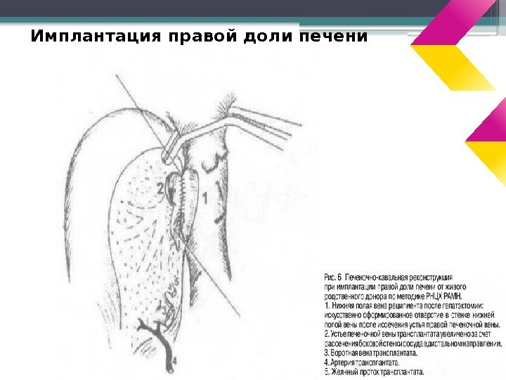 Имплантация правой доли печени     