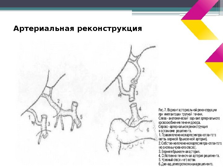 Артериальная реконструкция     