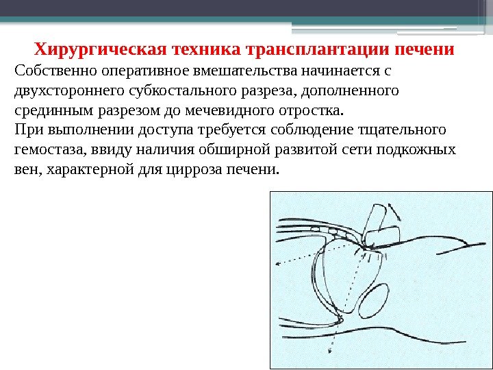 Хирургическая техника трансплантации печени Собственно оперативное вмешательства начинается с двухстороннего субкостального разреза, дополненного срединным