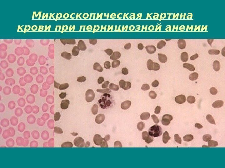 Микроскопическая картина крови при пернициозной анемии 
