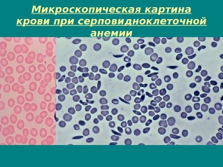 Микроскопическая картина крови при серповидноклеточной анемии 