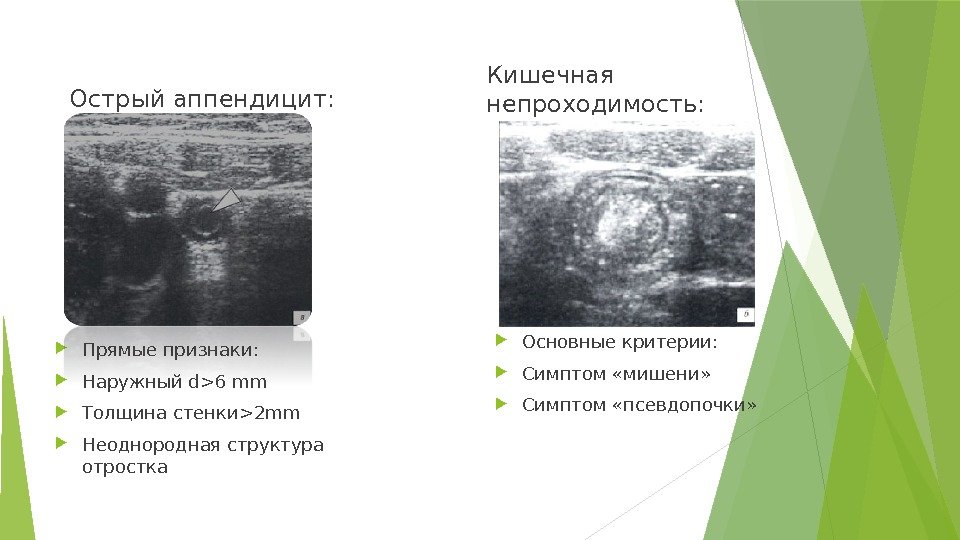 Острый аппендицит: Кишечная непроходимость:  Прямые признаки:  Наружный d6 mm Толщина стенки2 mm