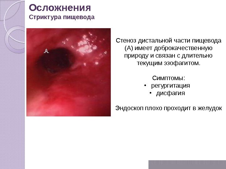 Стеноз дистальной части пищевода (А) имеет доброкачественную природу и связан с длительно текущим эзофагитом.