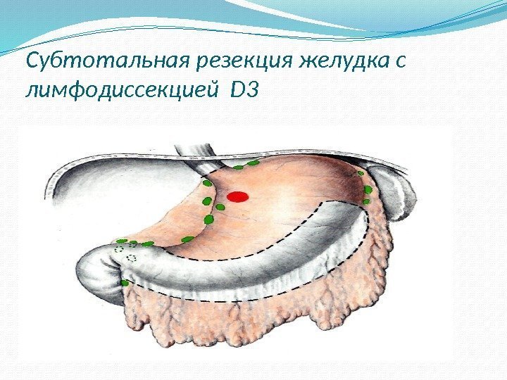 Субтотальная резекция желудка с лимфодиссекцией D 3 