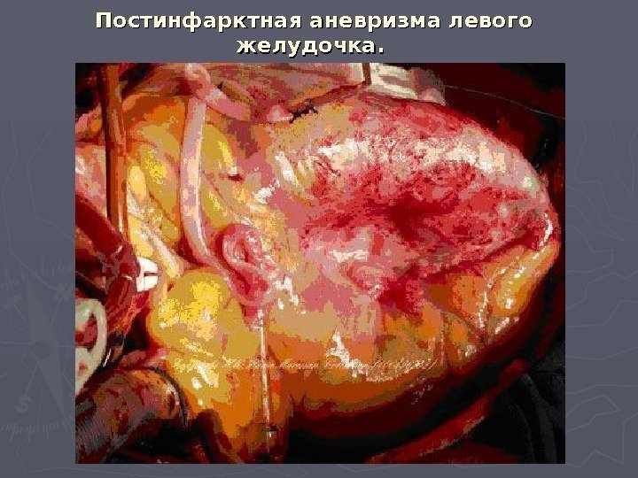 Постинфарктная аневризма левого желудочка.  