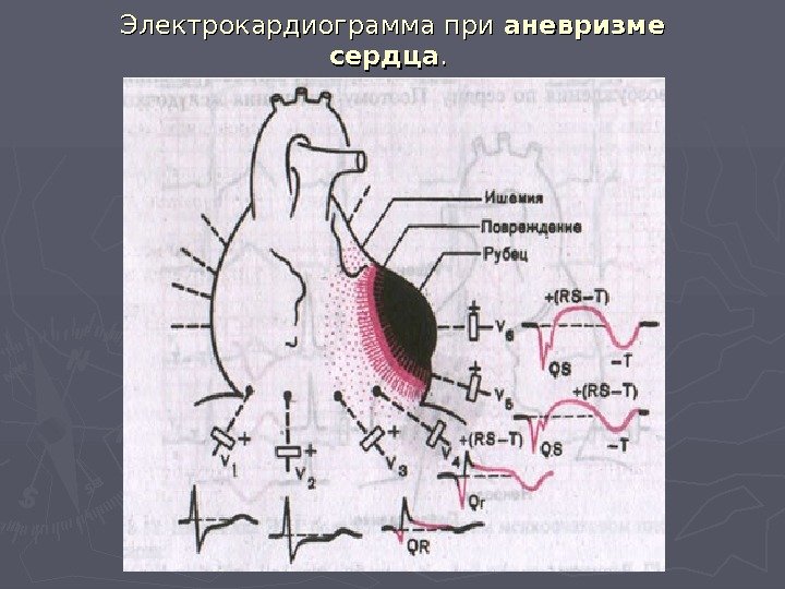 Электрокардиограмма при аневризме  сердца. .  