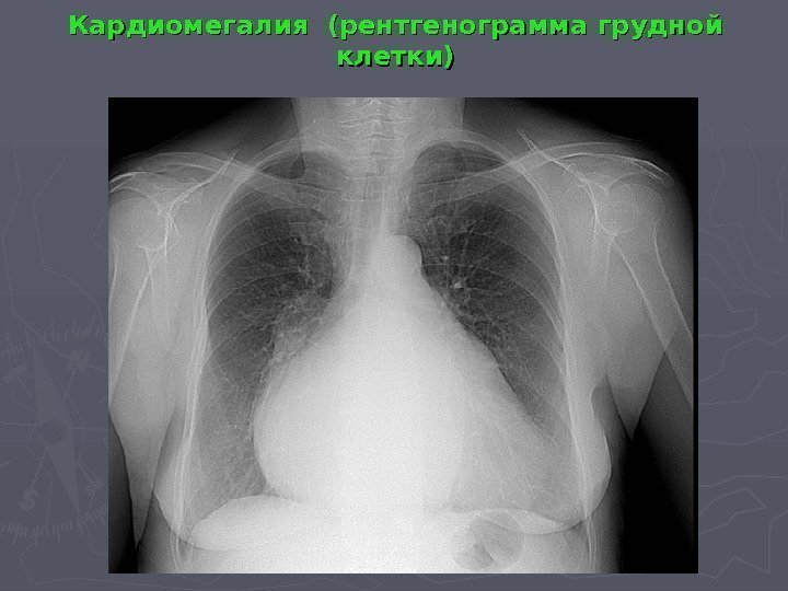 Кардиомегалия (рентгенограмма грудной клетки) 