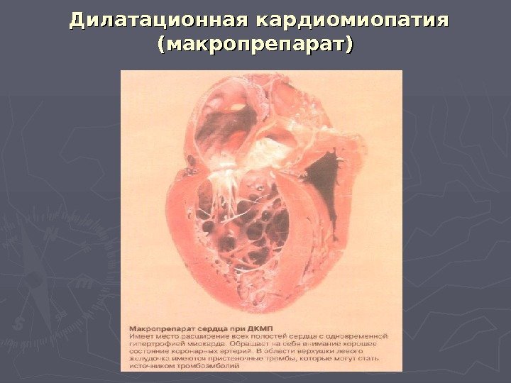   Дилатационная кардиомиопатия (макропрепарат) 