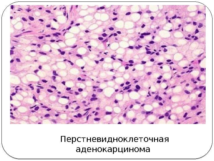 Перстневидноклеточная аденокарцинома  