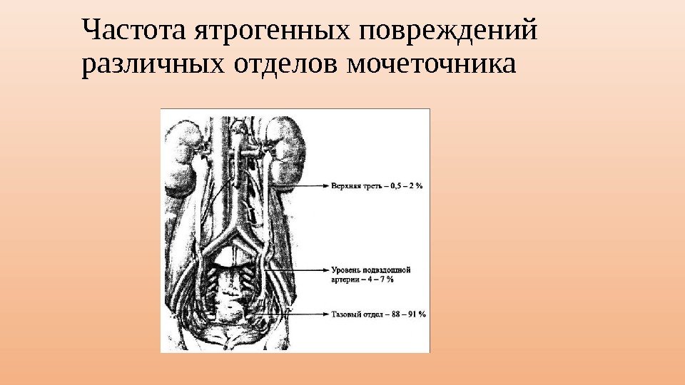 Частота ятрогенных повреждений различных отделов мочеточника 