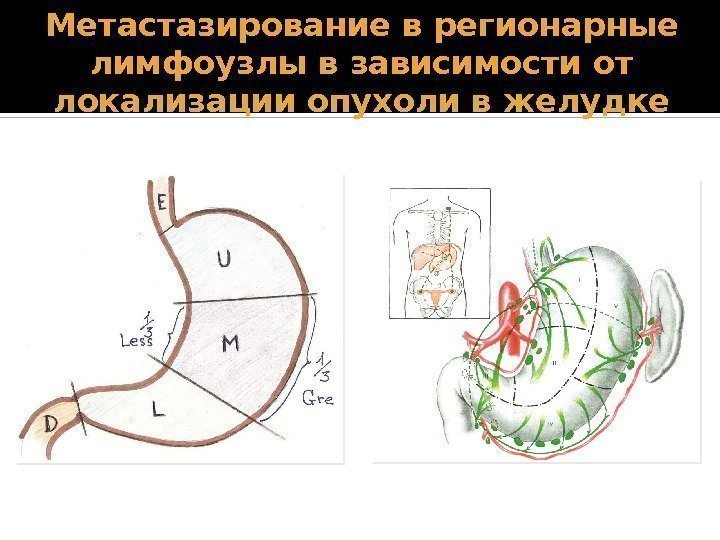 Метастазирование в регионарные лимфоузлы в зависимости от локализации опухоли в желудке  